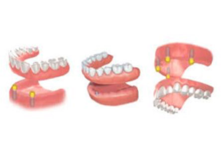 tipos de implante dental Arganda