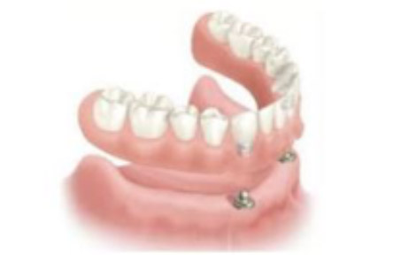 cómo colocar un implante dental Arganda