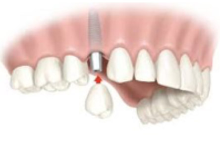 Tornillo de implante dental flojo
