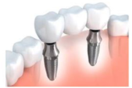 tornillo de implantes dentales