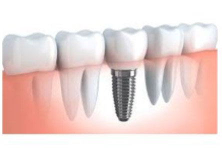 Tornillo de implante dental roto