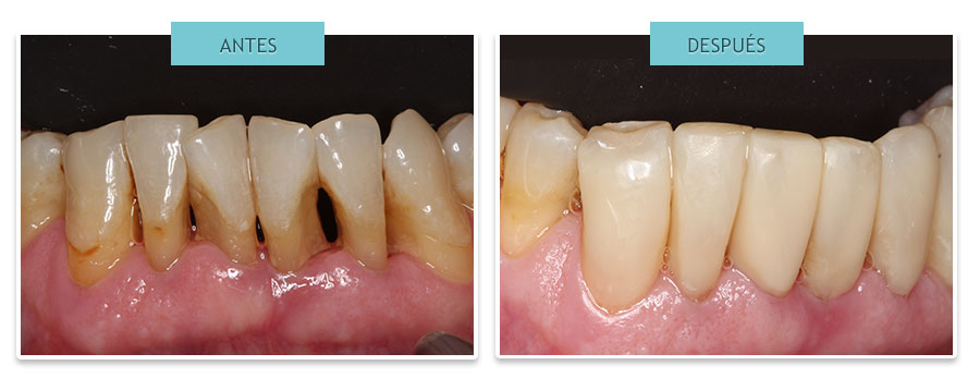 estética dental: Cerrar troneras