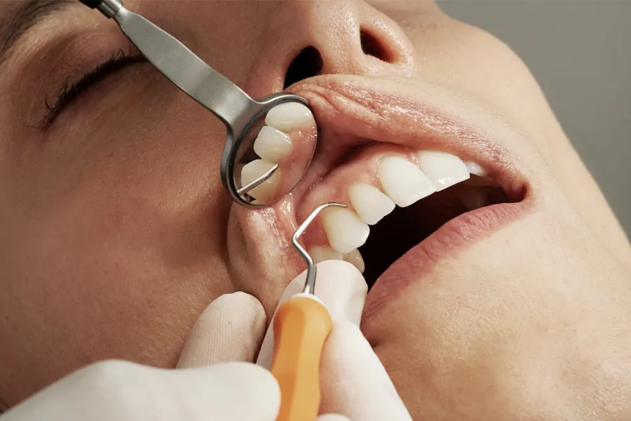 Cómo prevenir y tratar la enfermedad periodontal